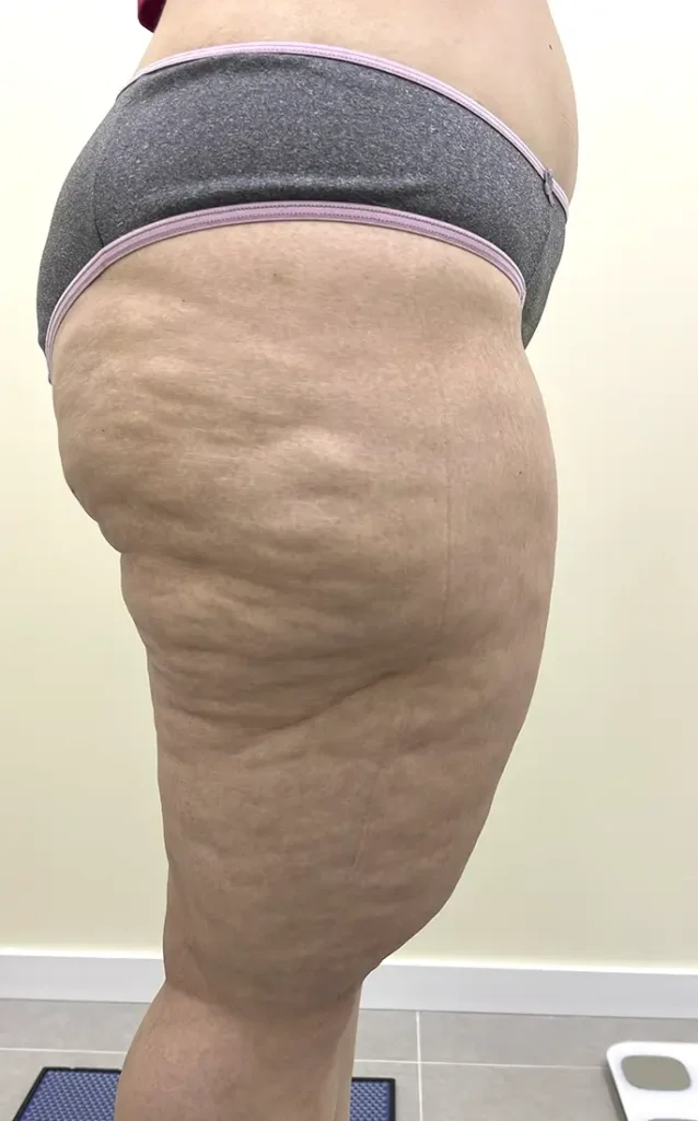 lipedema